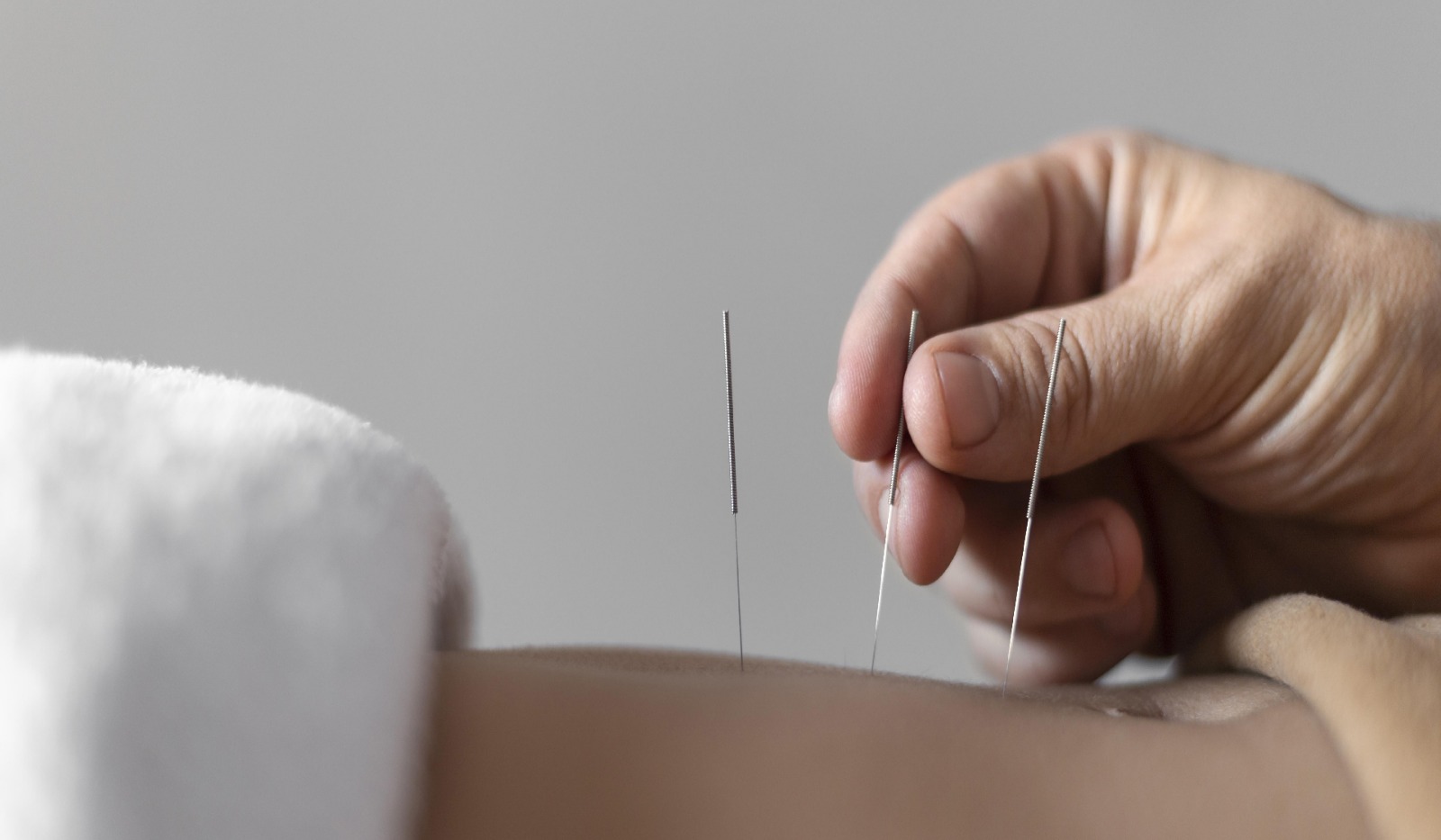 Akupunktur Medik di Bintaro: Solusi Medis Modern untuk Kesehatan & Estetika di RS Sari Asih